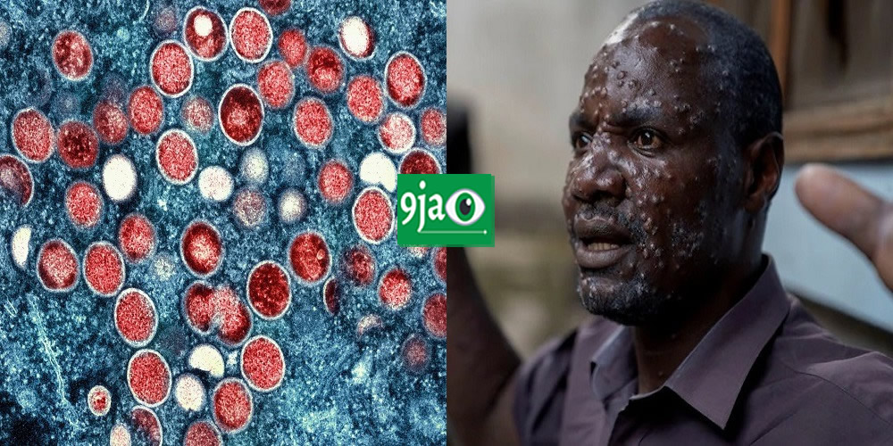 Mpox Outbreak in Africa: Over 17,000 Cases in 2024, Urgent Action Required