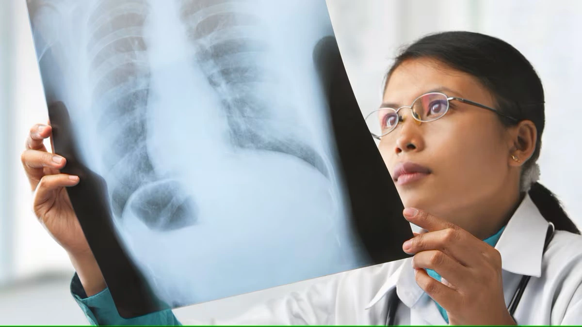 TB Now Leading Global Infectious Deaths, Surpassing COVID-19