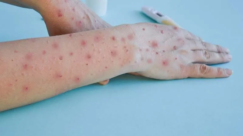 Mpox: UK Confirms Two New Cases, Total Now Three